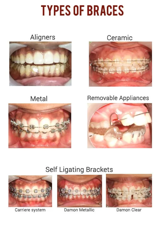 Dr.Mathesul Invisalign Orthodontist Braces & Dental Implant Clinic image 9